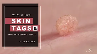 Skin Tags, Seborrheic Keratosis & Warts | What's the difference? - Dr Chiam CT