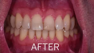 Soft Tissue Graft | Gum Grafting San Jose & Campbell CA | Ueno Dental Center Specialists