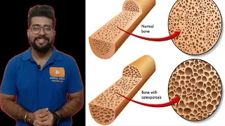 What Is a Bone Mineral Density Test? || Osteoporosis test in Hindi || Medical Guruji