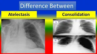 Difference between Atelectasis and Consolidation