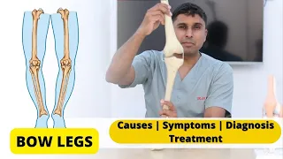 तिरछे घुटने का इलाज | How to Fix Bow Legs | Bow Legs Correction |Causes Symptoms Diagnosis Treatment