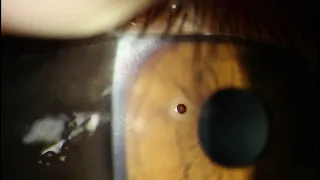 Cornea Metal Foreign Body Removed With Needle - Discovered to be Plastic!