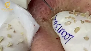 Blackheads and whiteheads extraction (362) | Loan Nguyen