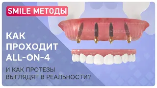 Что такое all-on-4? Видео об имплантации на 4 имплантах, как смотрятся протезы