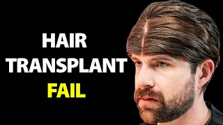 I Regret My Turkish Hair Transplant | Hair Surgeon Reacts