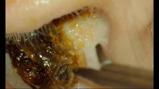 EAR WAX REMOVAL : MASSIVE PLUG : CAUSED HEARING LOSS