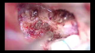 Tuberculum sella meningioma resection, redo +  opening of the optic canal and nerve decompression