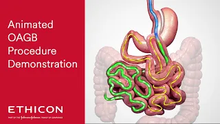 One Anastomosis Gastric Bypass (OAGB) Animated Patient Education Video | Ethicon