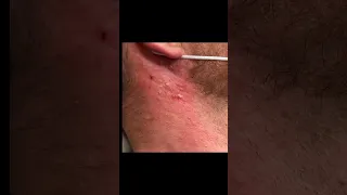 Saucy Blackheads