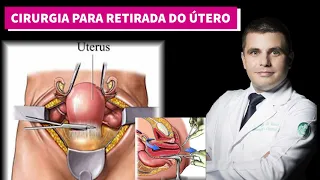 Histerectomia - A cirurgia para retirada do útero