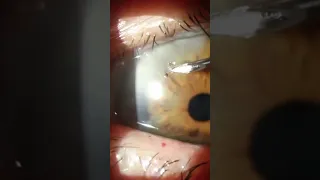 Corneal Foreign Body Removal #shorts