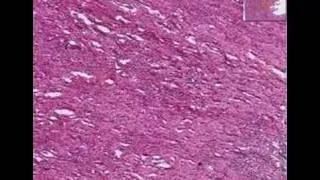 Histopathology Kidney-- Acute and chronic pyelonephritis