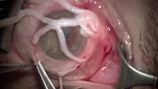 Corneal Neurotization for neurotrophic keratopathy