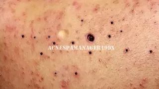 Happy Life With Blackheads & Acne Treatment 538