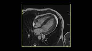 Coronavirus Myocarditis Magnetic Resonance Imaging (4-Chamber View)