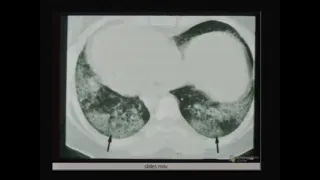 Imaging in Diffuse Parenchymal Lung Disease - Part 1