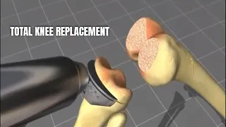 Total knee replacement surgery (3D medical Animation)