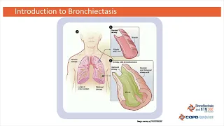 Introduction to Bronchiectasis with Tim Aksamit, MD