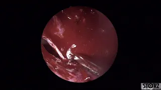 Endonasal Endoscopic Orbital Decompression for Refractory Meningioma