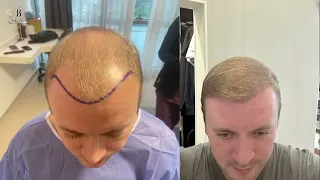 Hair transplant result of a patient with blonde hair and large baldness