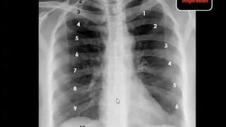 Imaging of Focal lung lesions X Ray chest   Dr mamdouh mahfouz