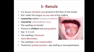 cysts of floor of mouth (ranula and sublingual dermoid cyst)