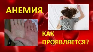 Анемия. Как проявляется?