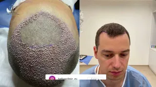 hair transplant in Bellus clinic / Istanbul