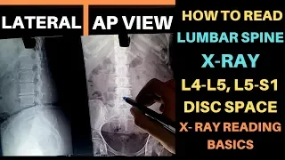 Lower Back X RAY How to Read, L4 L5 S1 Lumbosacral X Ray Reading, Lumbar Spine X RAY Complete Study