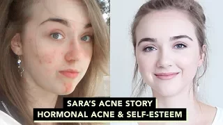 🌴How I Cleared Up My Skin : Sara's Acne Story • Confidence & Self-esteem with Acne