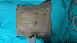 Hi Definiton Liposuction | Op. Dr. Arda Katırcıoğlu