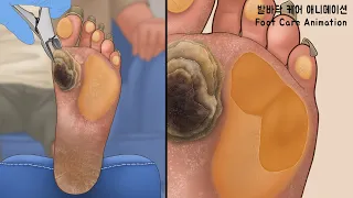 ASMR 딱딱하게 굳고 갈라진 발바닥을 깨끗하게! 과각화증, 사마귀, 굳은살, 티눈 제거 애니메이션 | Calluses, Plantar Warts, Corn