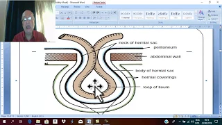 Hernia in English 3 ( External  abdominal hernia , part 2) , by Dr. Wahdan .