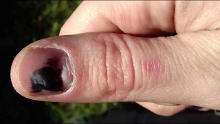 Bruised Thumbnail Growing Out Time Lapse