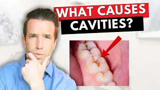 What Causes Cavities? | Everything You Need To Know