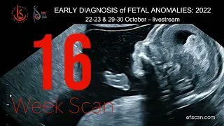 16 Week Anomaly Scan - EARLY DIAGNOSIS of FETAL ANOMALIES 2022