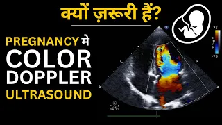 Color Doppler Ultrasound in Pregnancy in Hindi - क्या हैं? क्यों करते हैं? कैसे करते हैं?