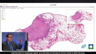 Lung Granulomas Caused by Fungal Infection