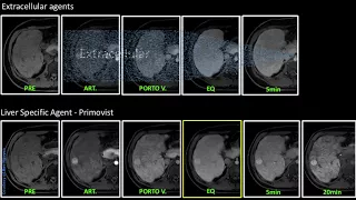 Liver Specific agent (Primovist) vs Extracellular agent @ Siemens 1.5T Aera