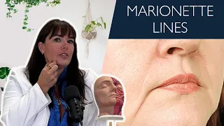 How to Treat Marionette Lines Non-Surgically