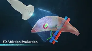 Liver cancer treatment (3D Medical animation) 2022