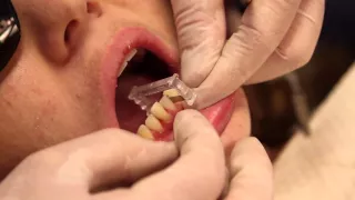 Composite Addition Dentistry - Lecture by Dr. Brian Mills