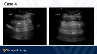 POCUS in Trauma 3 - Typical Findings