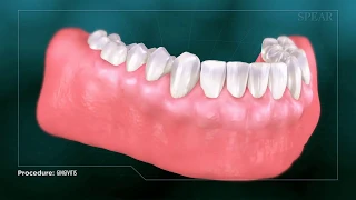 Gingivitis - Inflamed Gums