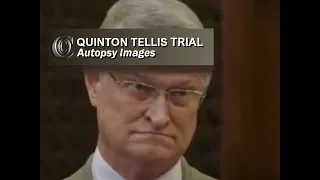 QUINTON TELLIS TRIAL - 👨‍⚕️ Dr Hickerson (Autopsy pics) (2017)