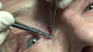 Medial Canthoplasty