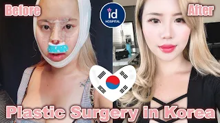 Plastic Surgery in Korea Pt  2 Before & After, Recovery, V line and Rhinoplasty   ID Hospital