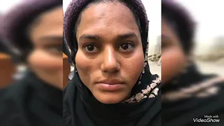 Face changing surgery ( Fat transfer face in Pakistan by dr Saleem)