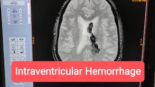 How to Diagnose Intraventricular Hemorrhage on MRI of Brain.