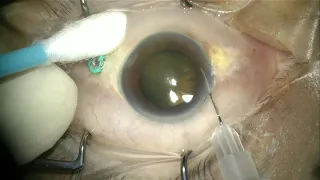 Anterior chamber  or aqueous tap in phakic eye